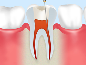 根管治療とは