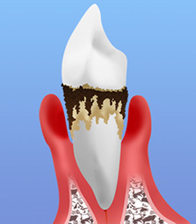 歯周病とは