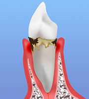 初期の歯周病（歯肉炎）