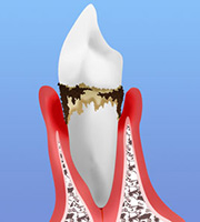 中期の歯周病