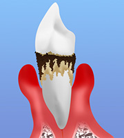 重度の歯周病